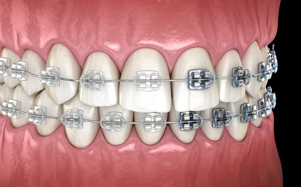 3D illustration comparing clear ceramic braces and metal braces on the same teeth – ceramic vs metal braces